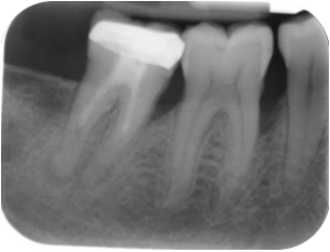 Before-Dental-Laser-Bone-Gone