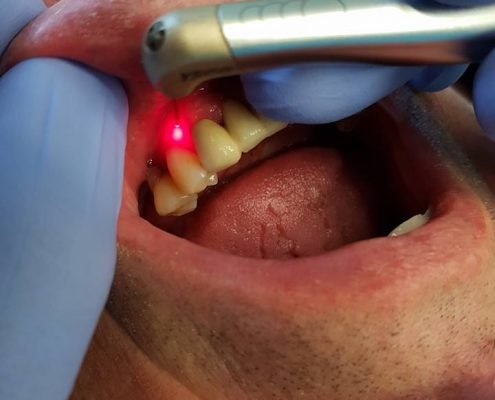 laser treatment at leading Farnborough dentist