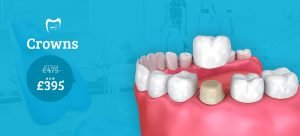 Dental Crowns at leading Farnborough dentist